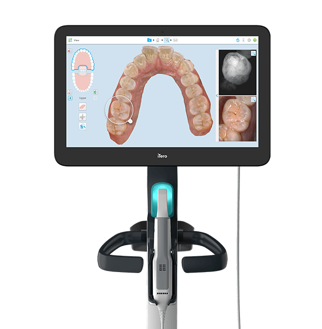 Scanner iTero para planejamento digital do sorriso